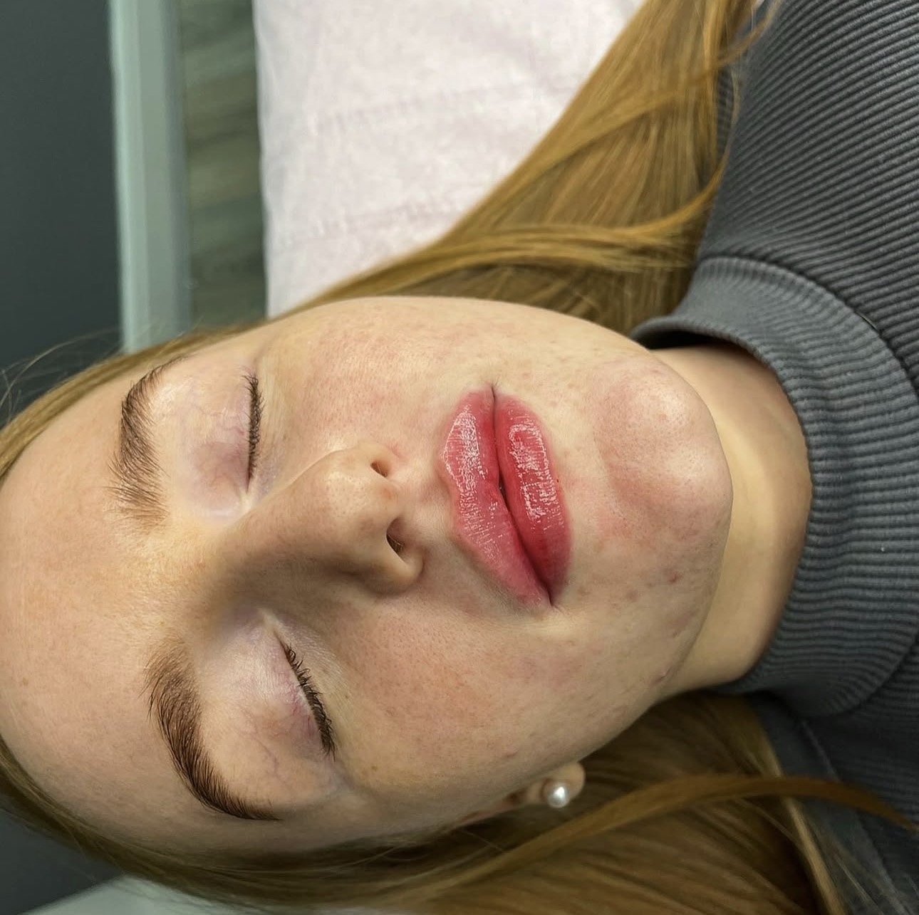 Lips after filler treatment